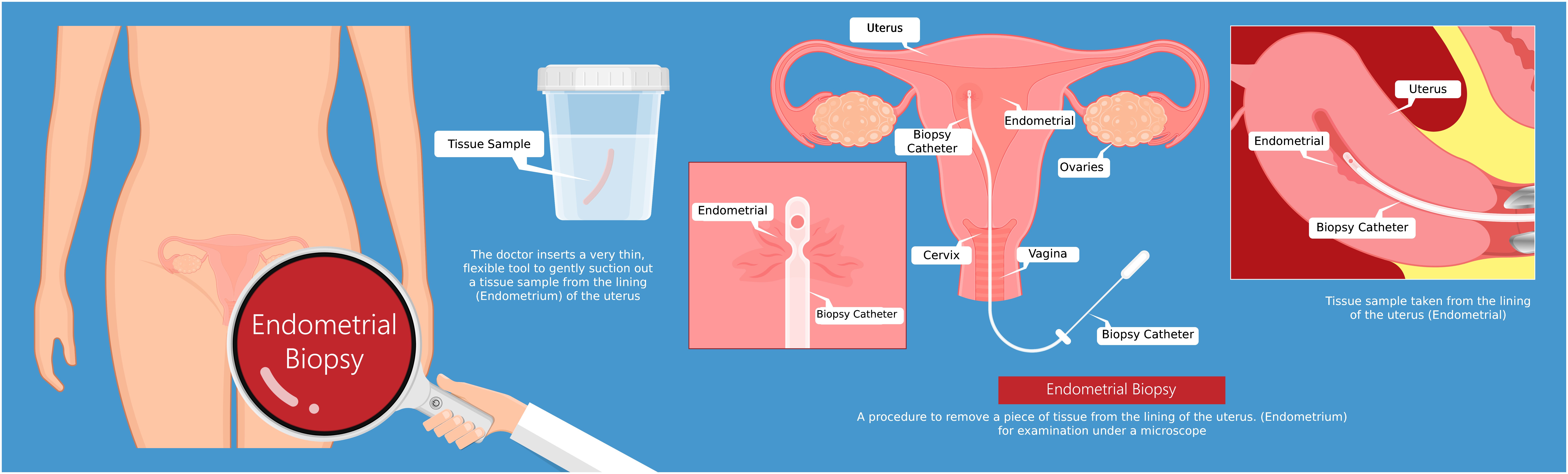 Endometrial Biopsy (1)